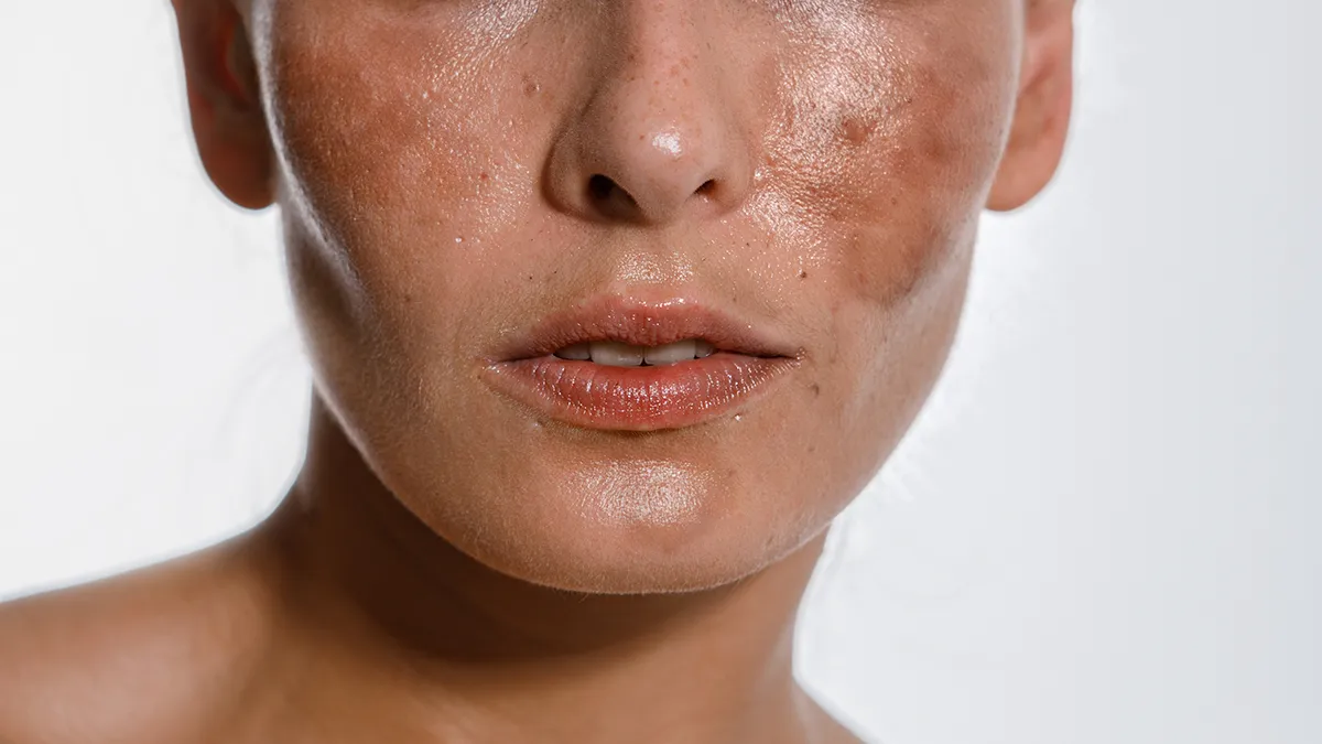 A lower face of the woman with pronounced hyperpigmentation